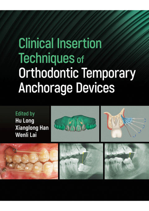 Clinical Insertion Techniques of Orthodontic Temporary Anchorage Devices 1st Edition