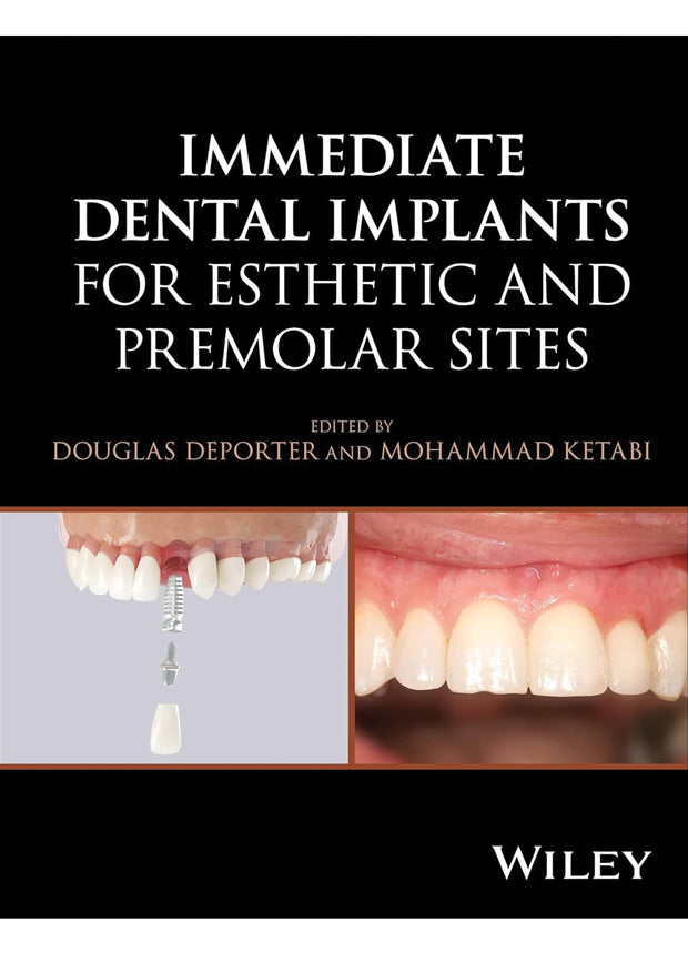 Immediate Dental Implants for Esthetic and Premolar Sites