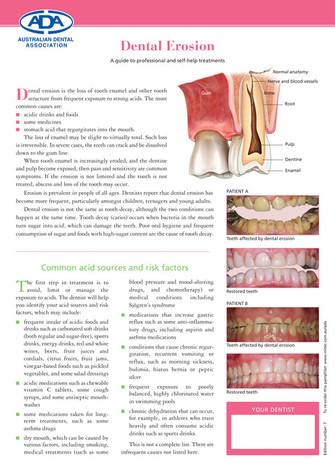 Dental Erosion