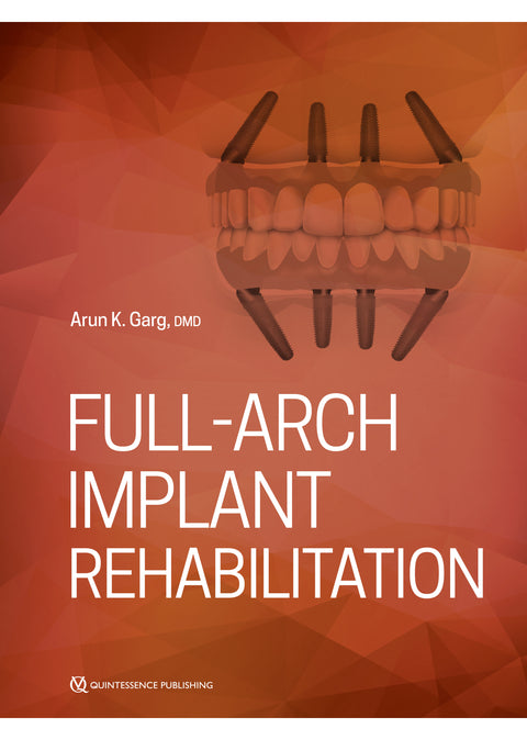 Full-Arch Implant Rehabilitation