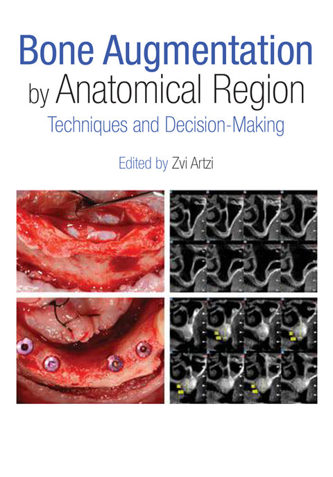 Bone Augmentation by Anatomical Region: Techniques and Decision-Making