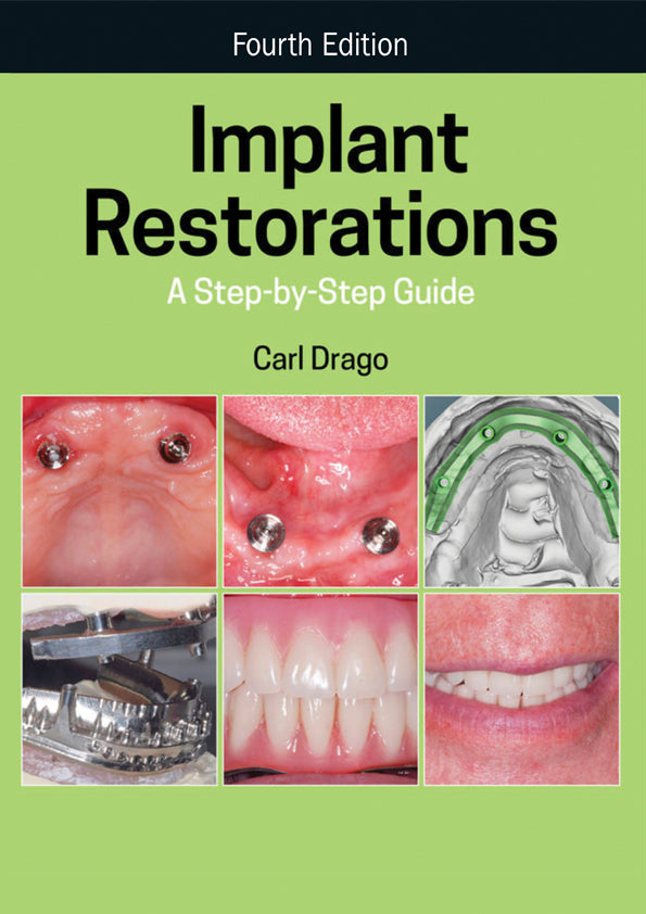 Implant Restorations: A Step-by-Step Guide