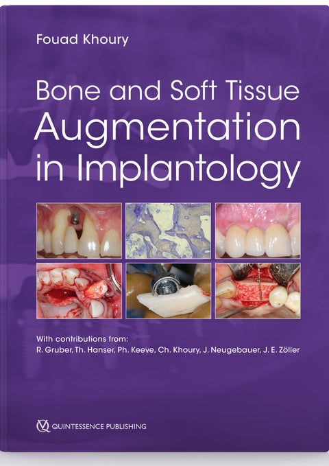 Bone and Soft Tissue Augmentation in Implantology