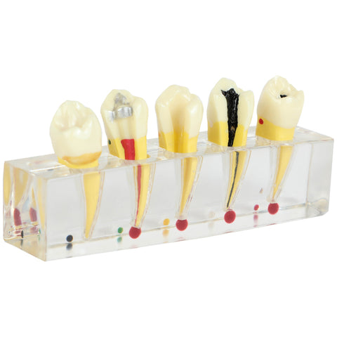 5-stage Endodontic treatment model