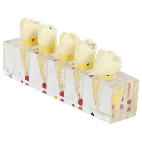 5-stage Endodontic treatment model