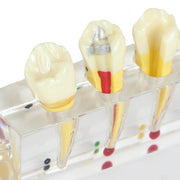 5-stage Endodontic treatment model