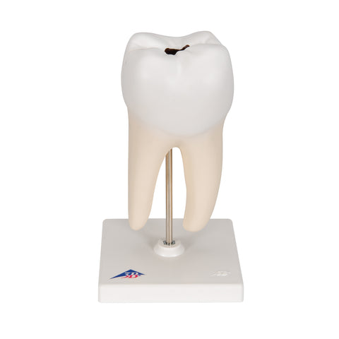 Lower Twin-Root Molar showing cavities, 2 part