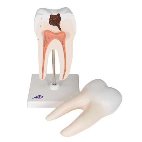 Lower Twin-Root Molar showing cavities, 2 part