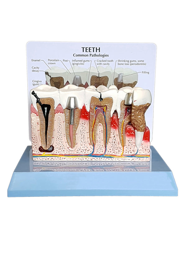 Diseased teeth and gum model