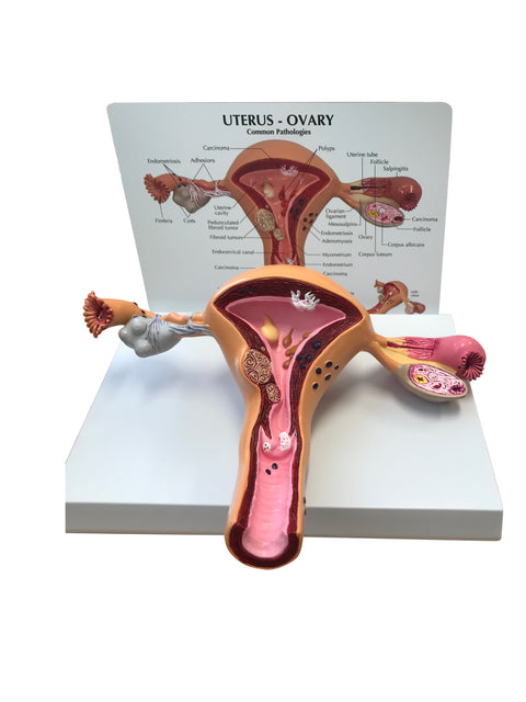 Uterus and Ovaries Model with Pathologies